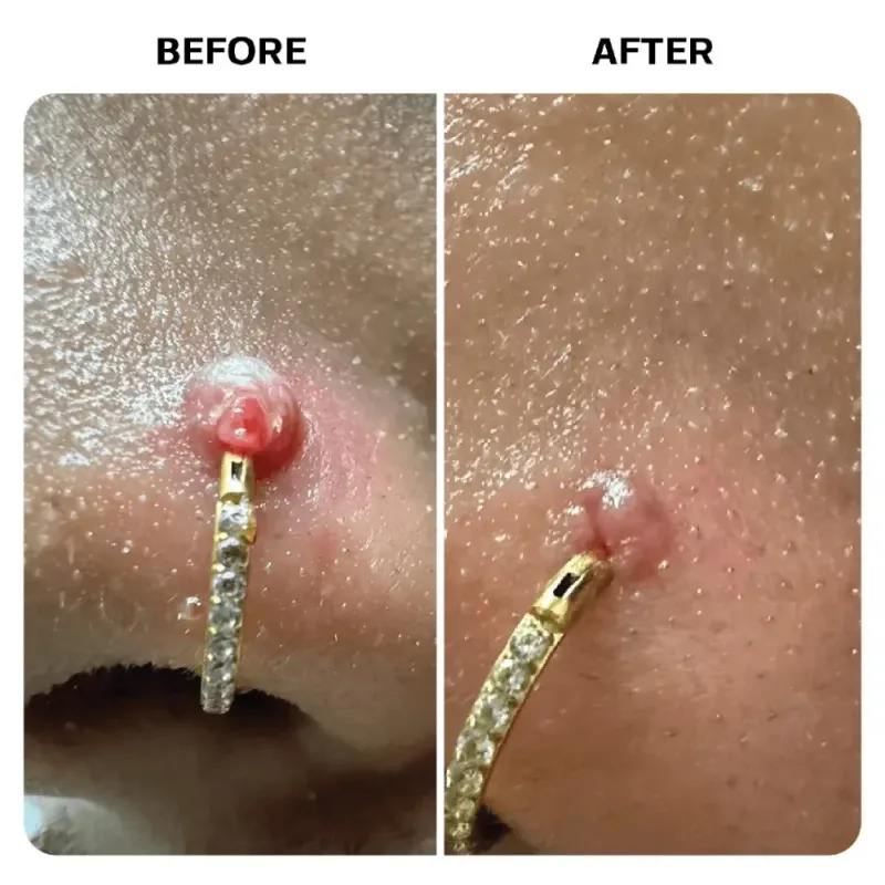 Keloid Repair Duo